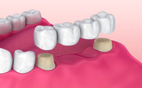 ponti dentali intervento